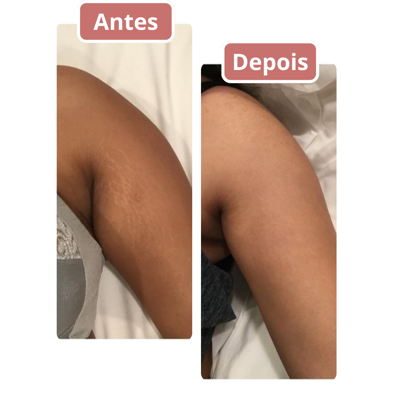 ⭐⭐⭐⭐⭐Jaqueline AlmeidaMinhas estrias me incomodavam há anos. Antes do Butt Up Cream, eu achava que nada poderia ajudar. Depois de usar o creme diariamente, as estrias diminuíram significativamente e minha pele ficou mais hidratada. Me sinto muito mais confiante agora.