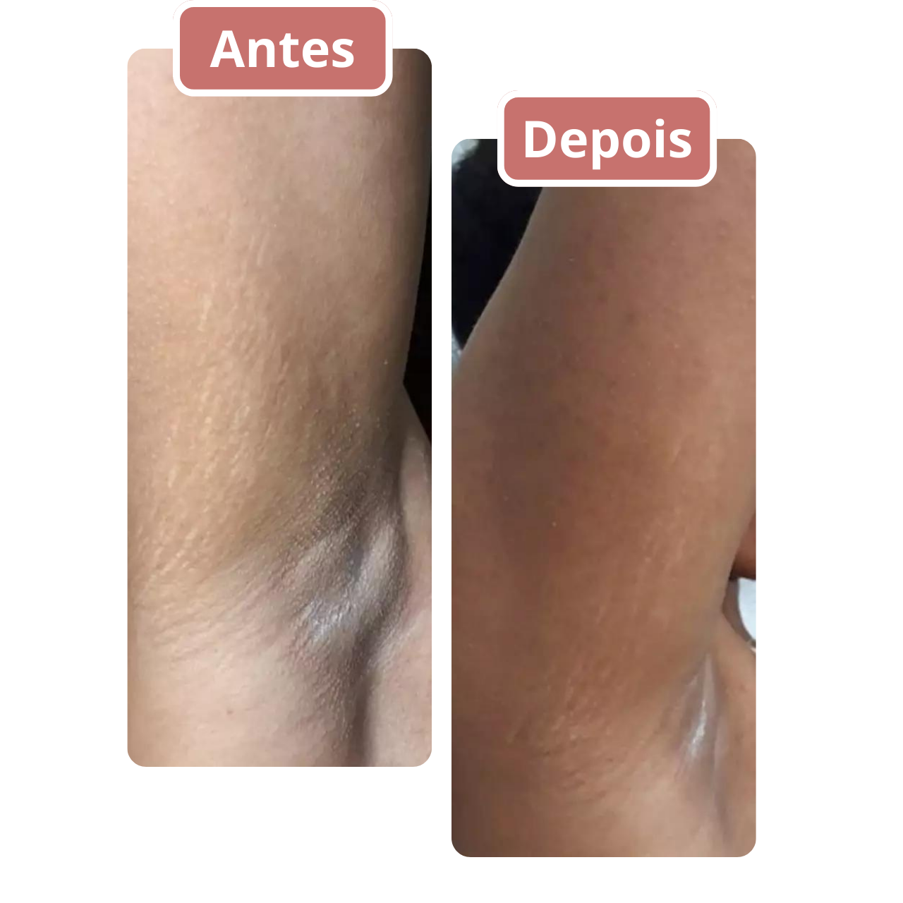 ⭐⭐⭐⭐⭐Mariana FerreiraAntes de usar o Butt Up Cream, as estrias no meu braço me deixavam muito insegura, especialmente no verão. Depois de algumas semanas aplicando o creme, percebi uma redução significativa nas estrias e minha pele ficou muito mais firme. Agora posso usar roupas curtas sem me preocupar. Estou muito feliz com os resultados!